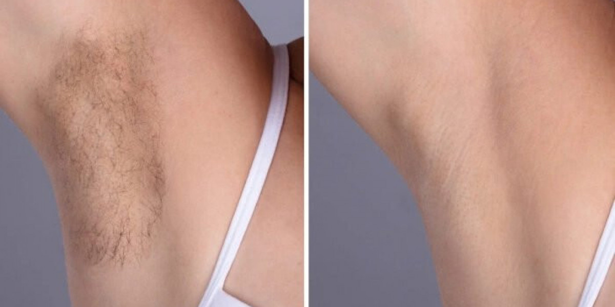 Best Plastic Surgeons in dubai with High Success Rates in Laser Hair Removal