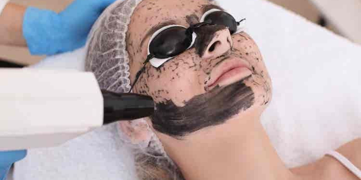 Laser Carbon Peel at Royal Clinic – The Hollywood Glow Secret