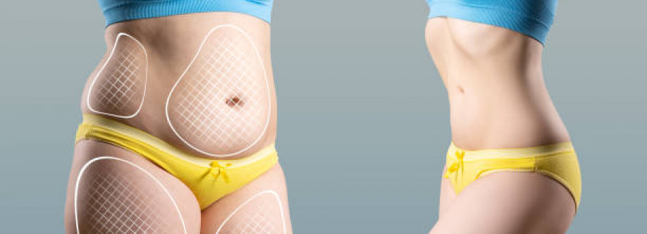 Liposuction in Riyadh saudia Cover Image